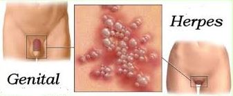 Illustration for article titled Obat penyakit herpes di badan